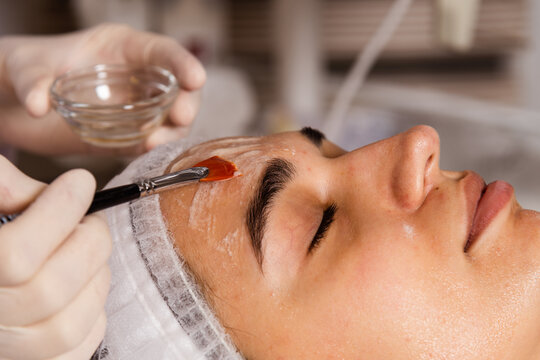 Chemical Peels in Islamabad