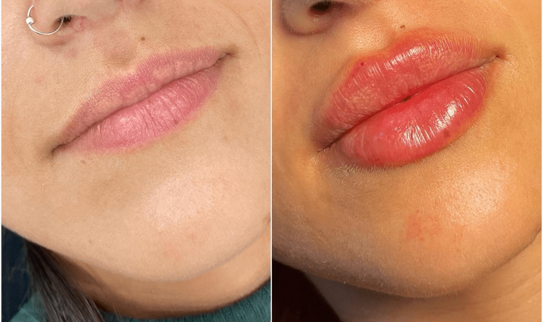 Juvederm in Dubai