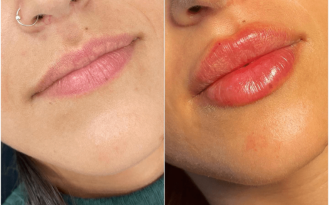 Juvederm in Dubai