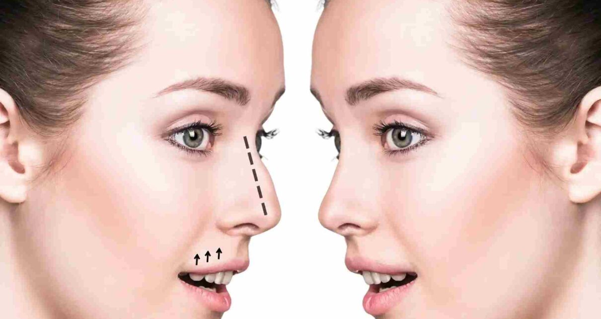Rhinoplasty in Dubai