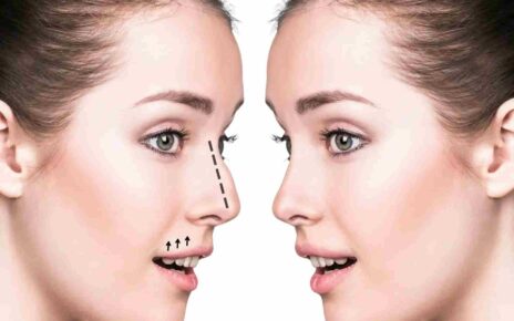 Rhinoplasty in Dubai