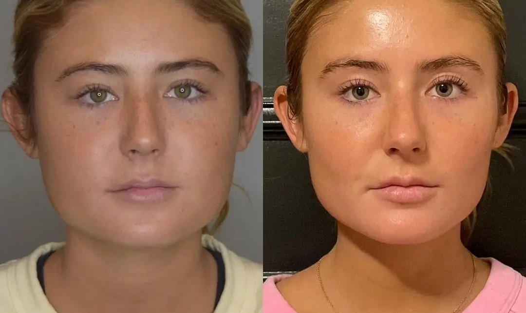 Buccal Fat Removal in Dubai