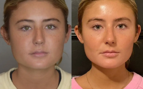 Buccal Fat Removal in Dubai