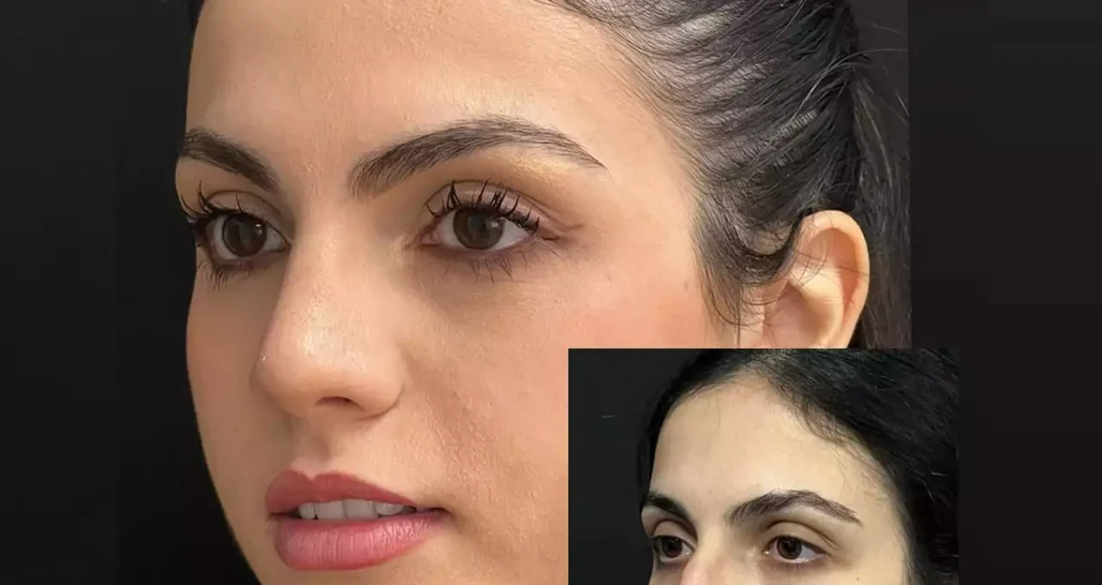 Rhinoplasty in Dubai