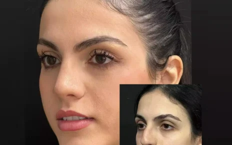 Rhinoplasty in Dubai