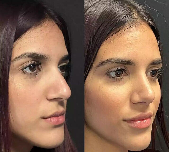 Septoplasty in Dubai